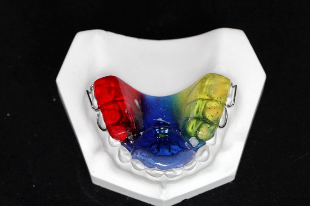 推簧頜墊矯治器(不含擴(kuò)弓器)